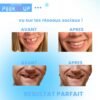 dent provisoire peekup